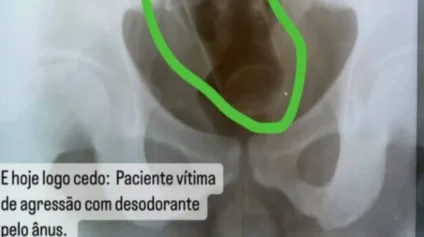 INUSITADO: Prefeitura de Ingá demite médico por vazar raio-x de paciente com desodorante no ânus